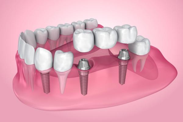 Dental crown&bridge