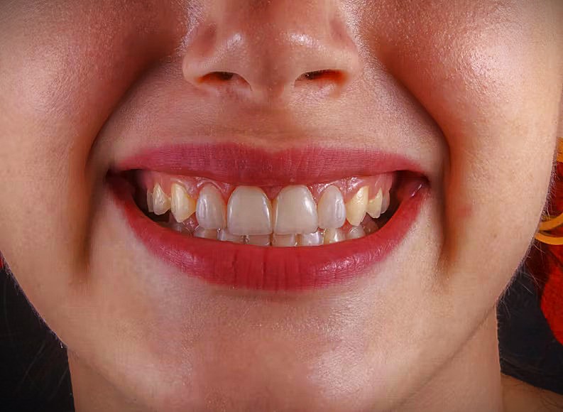 Teeth Whitening